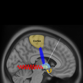 Brain activity discovery could transform Parkinson’s treatment